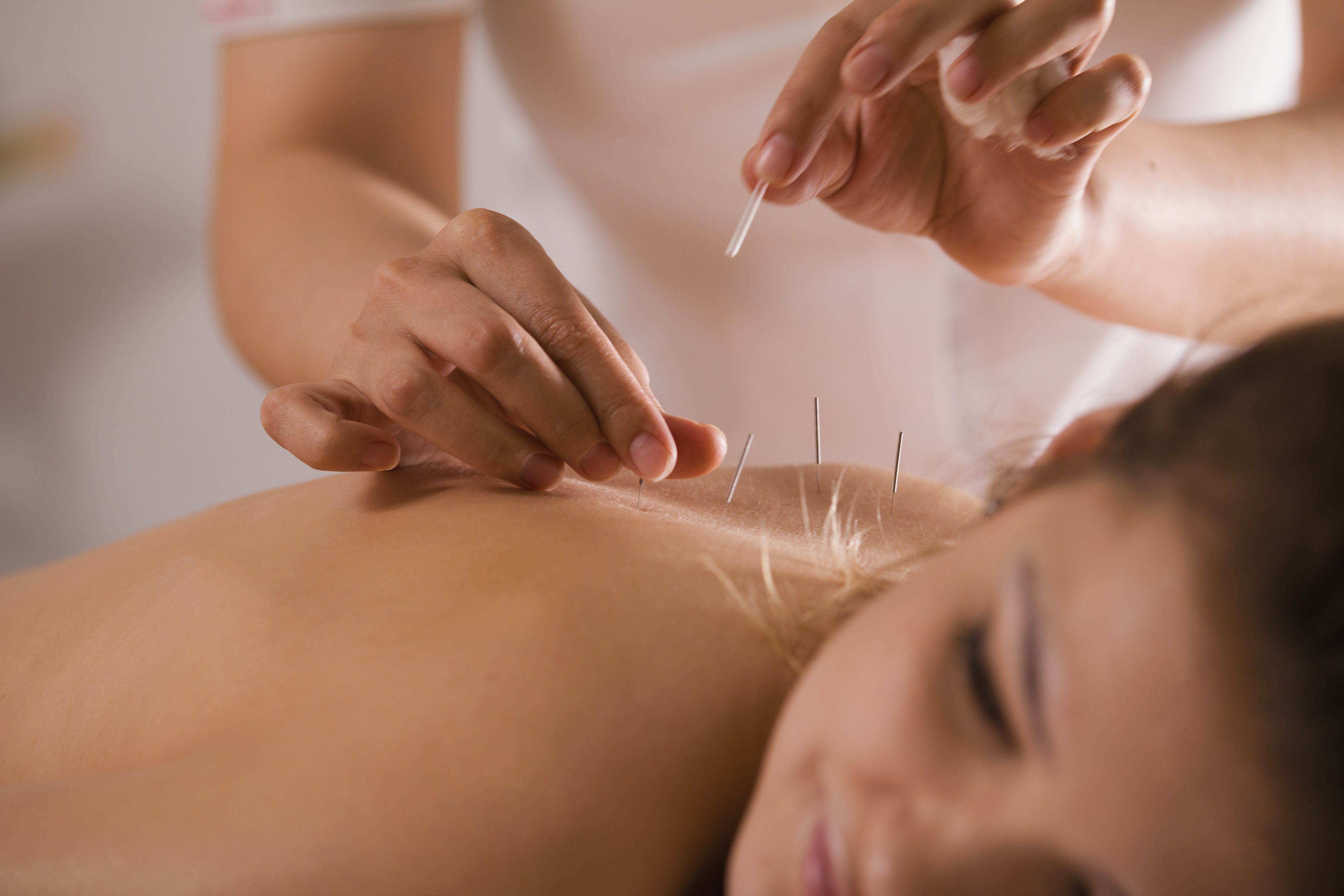 Acupuncture | Barnett Chiropractic & Acupuncture Clinic | Mankato Acupuncture